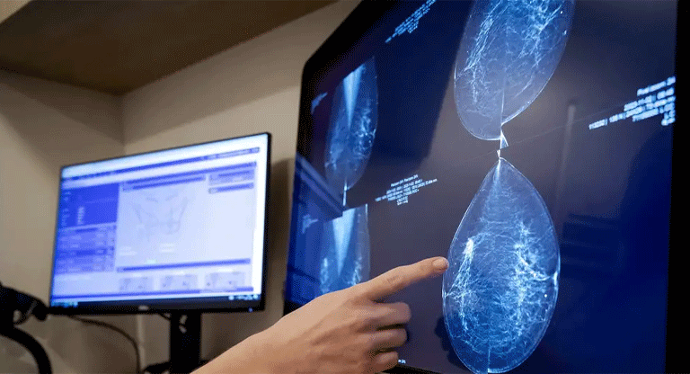 Cáncer de mama: la IA revela lo invisible para los médicos