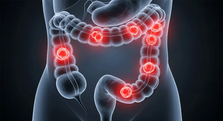 Vacuna experimental logra activar las defensas contra el cáncer de colon hereditario