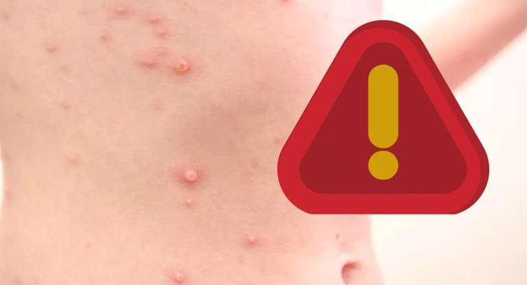 OPS emite alerta epidemiológica en América por aumento de casos de sarampión