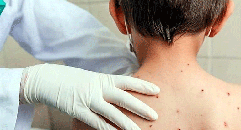 Alerta sanitaria: Confirman 11 casos de sarampión en El Salvador