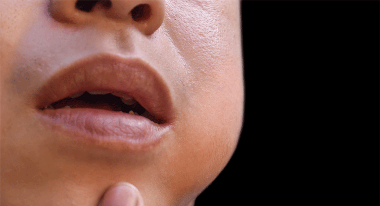 Registran brote de paperas y autoridades sanitarias activan vigilancia epidemiológica