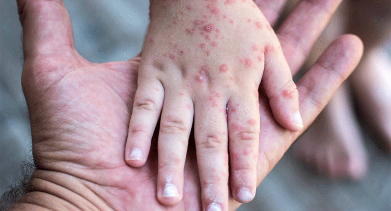 El sarampión ha regresado a El Salvador después de 30 años de silencio